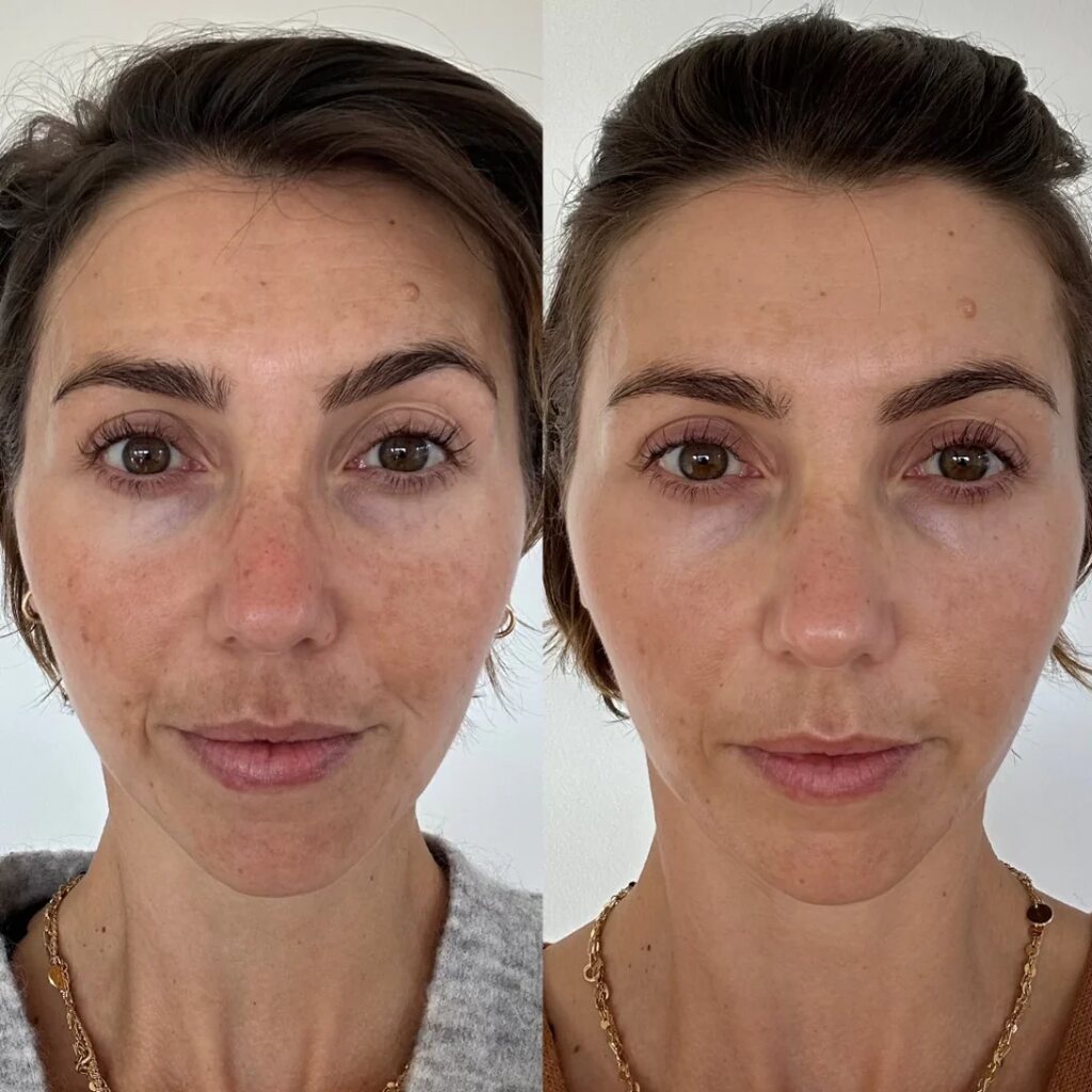 Microneedling before and after over one treatment, showing skin texture and hyperpigmentation at the Fulham studio