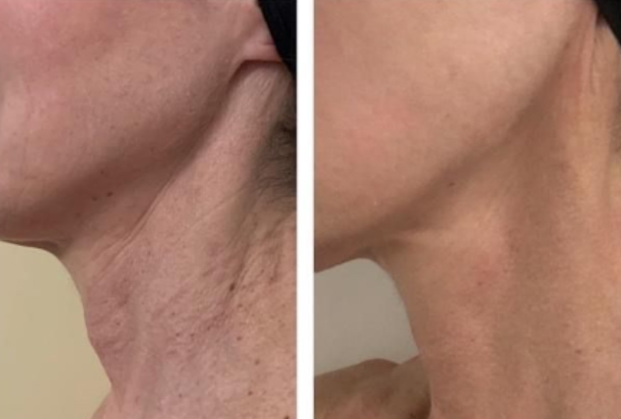 Polynucleotides before and after neck treatment showing tighter smoother skin in Fulham