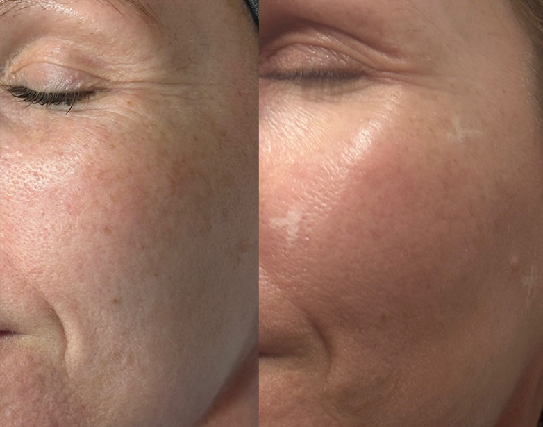 Profhilo before and after showing smoother, more hydrated skin with improved radiance, Fulham SW6