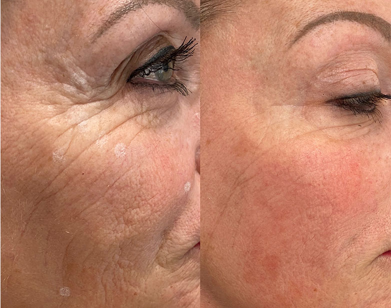 Profhilo before and after showing reduced fine lines and improved skin texture around the eye area, Fulham London