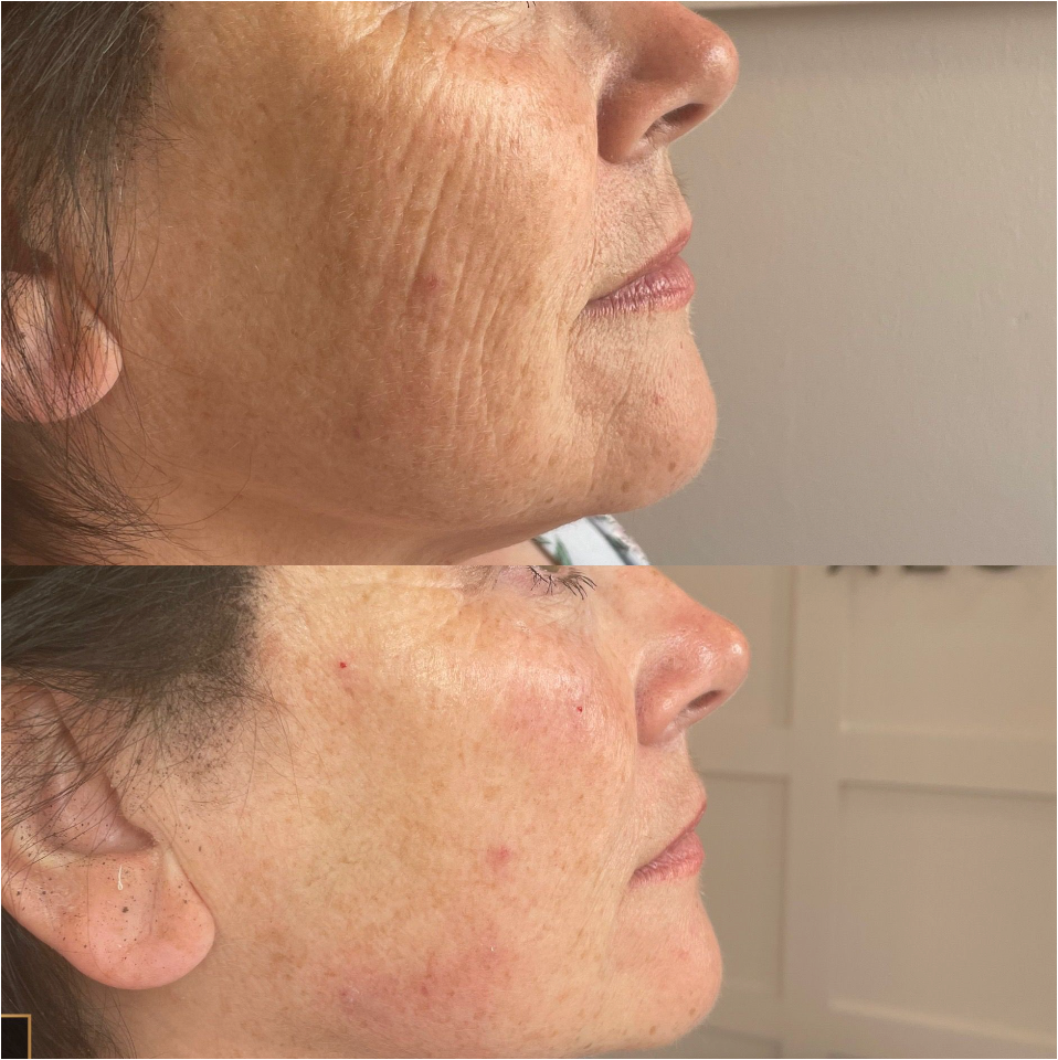Polynucleotides before and after face treatment showing improved skin texture and firmness in Fulham London