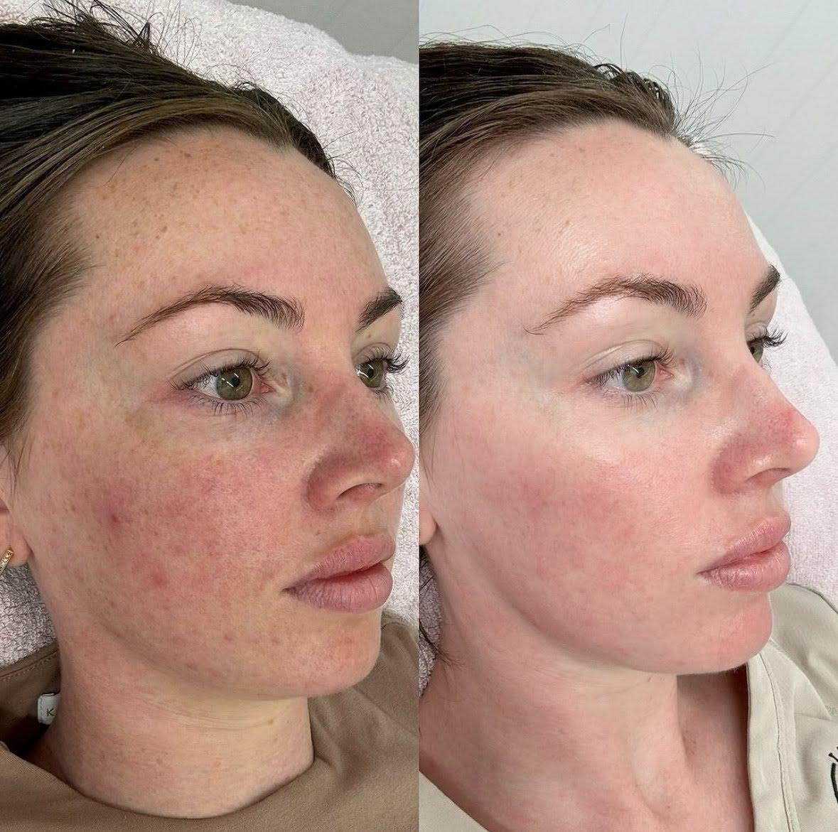 Before and after BioRePeel Resurfacing, a client's cheek in profile showing reduced redness and more even skin tone.