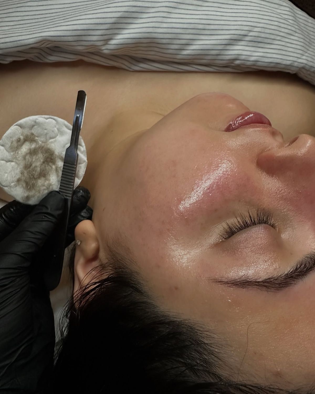 Dermaplaning facial in progress, with a sterile blade and a cotton pad holding removed surface debris beside a client’s prepared skin.