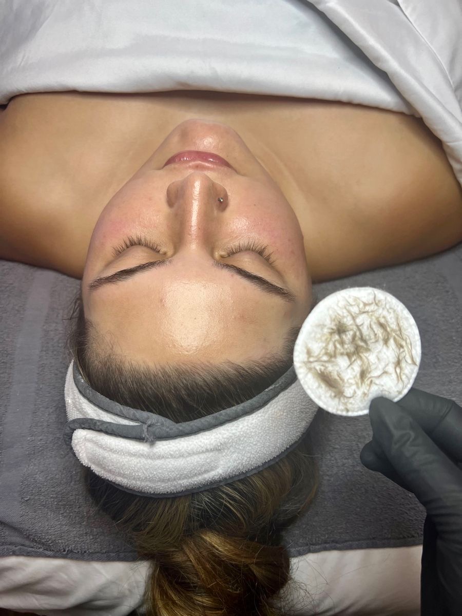 A client resting during a dermaplaning facial, with a gloved hand holding a cotton pad showing fine vellus hair and surface debris removed from the skin.