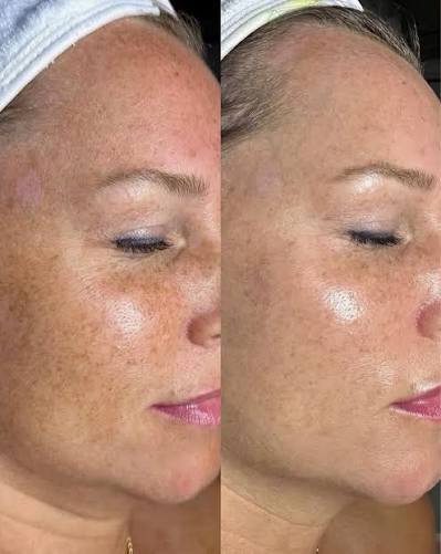 Before and after KRX Green Sea Peel, a client's cheek in profile showing softened pigmentation and smoother, more even skin texture.