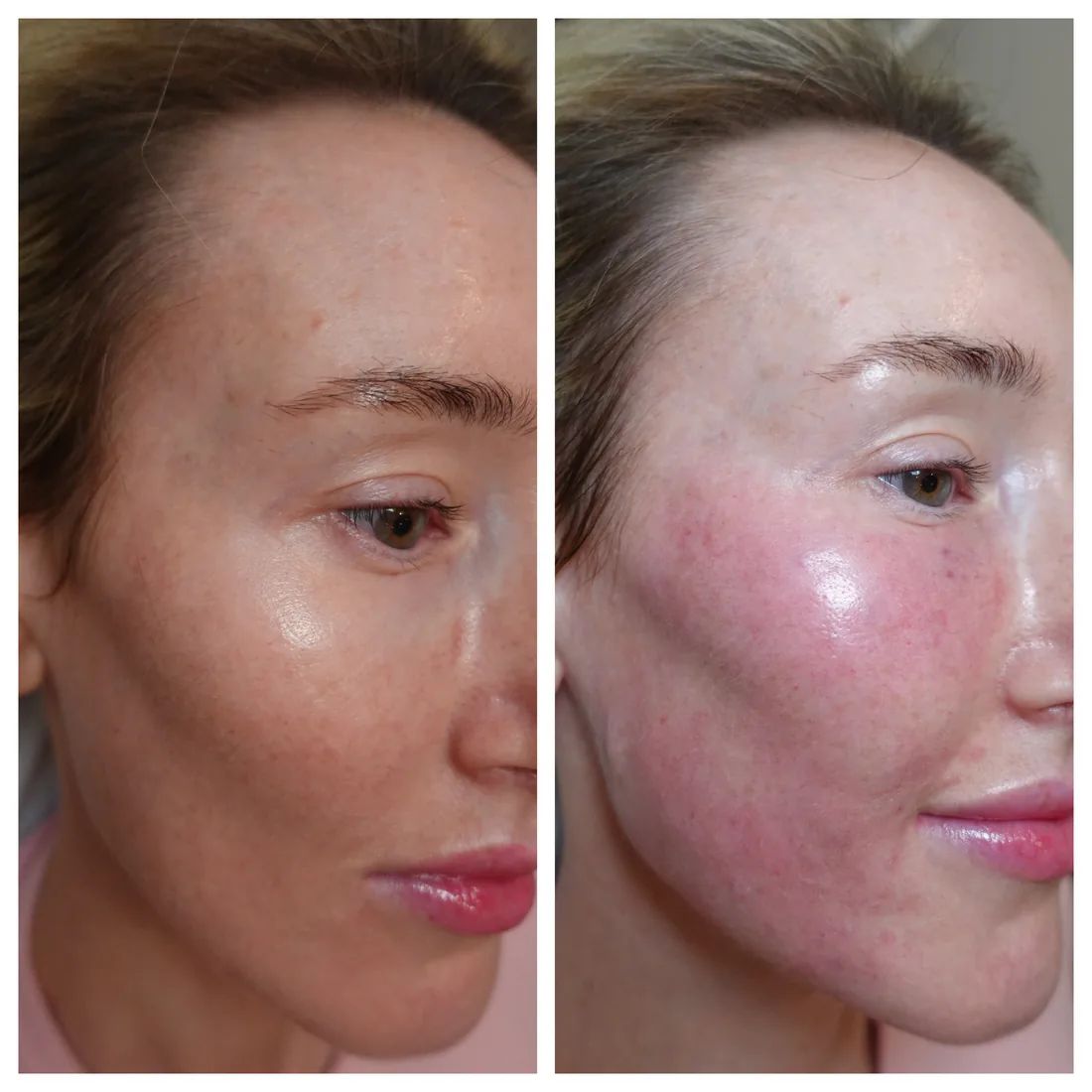 Polynucleotides before and after under eye treatment Fulham London, front view, before treatment on the left and immediately after on the right