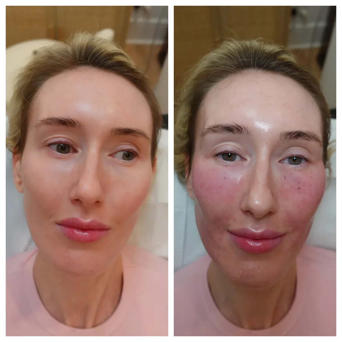 Polynucleotide skin booster treatment before and immediately after, side profile, Georgina Sookias Fulham London