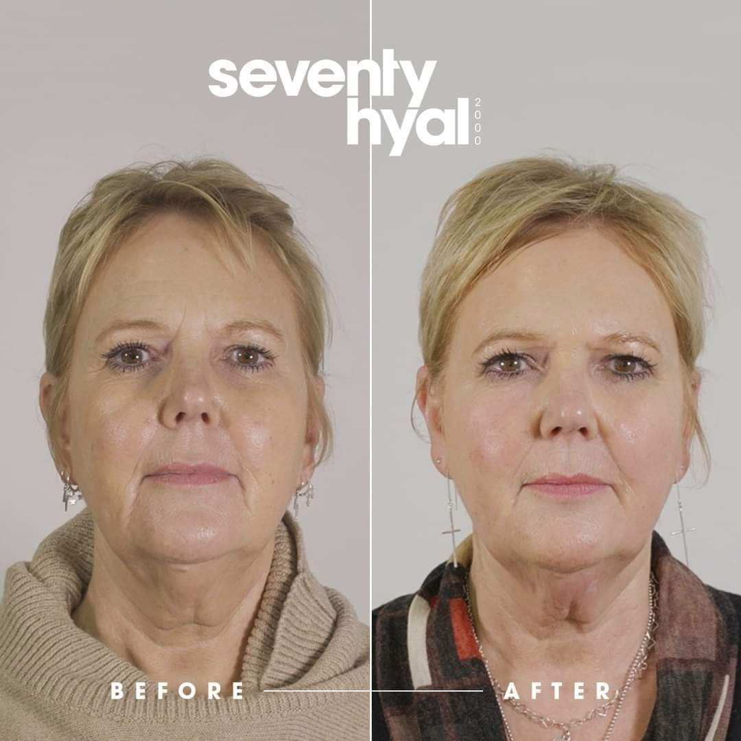 Seventy Hyal 2000 manufacturer example showing a woman's face before and after treatment, with improved skin quality and firmness. Brand example image, individual results vary.