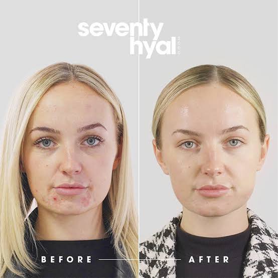 Seventy Hyal 2000 manufacturer example showing a face before and after treatment, with clearer, more hydrated and even-looking skin. Brand example image, individual results vary.