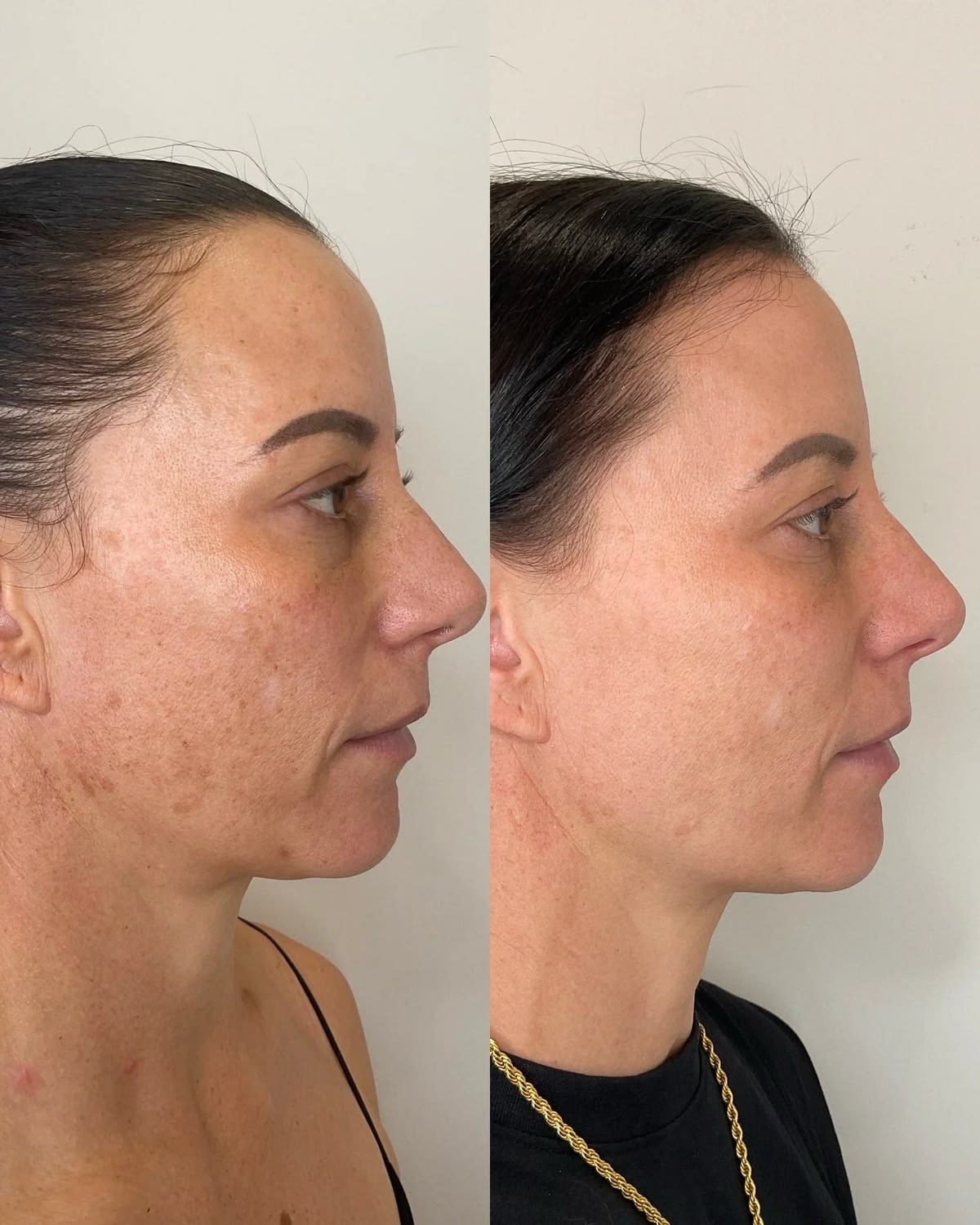 Before and after showing uneven pigmentation on facial skin
