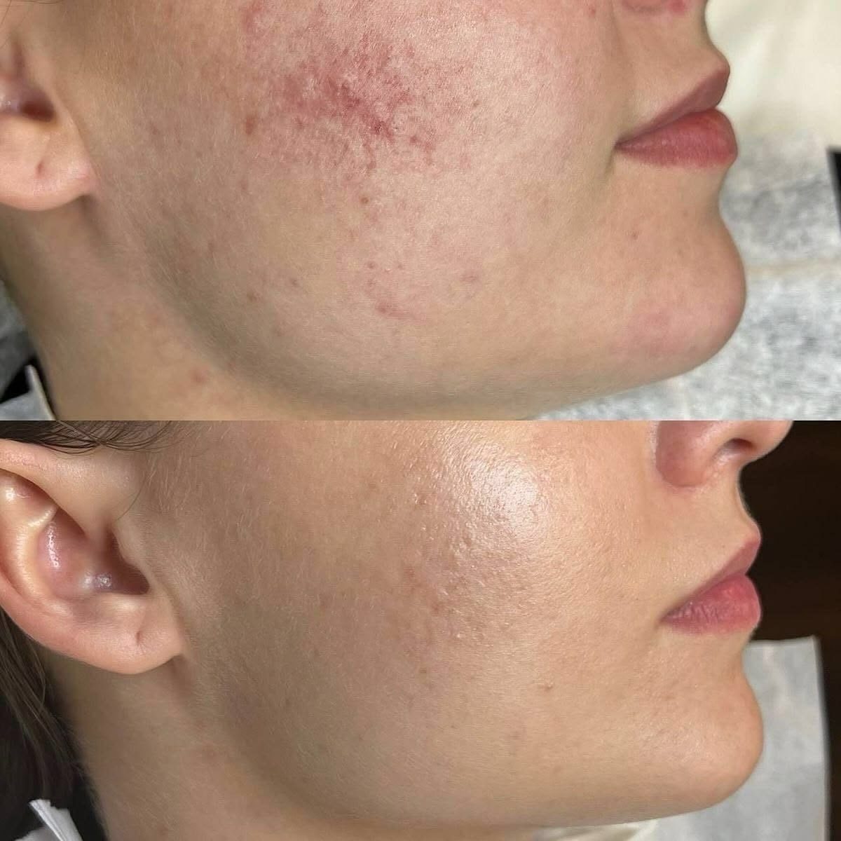 Before and after showing an established scar on the skin