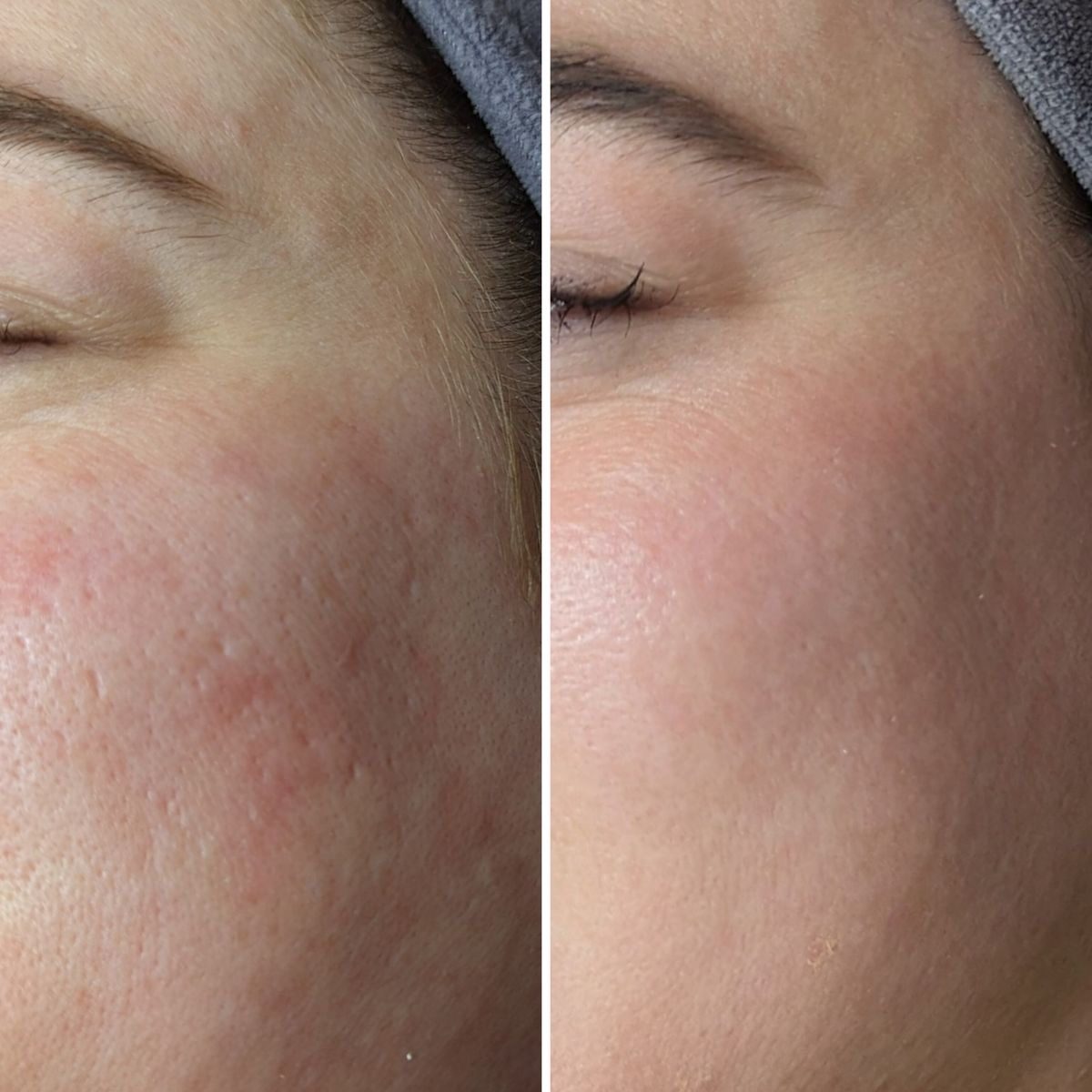 Before and after close-up of cheek skin showing texture and enlarged pores