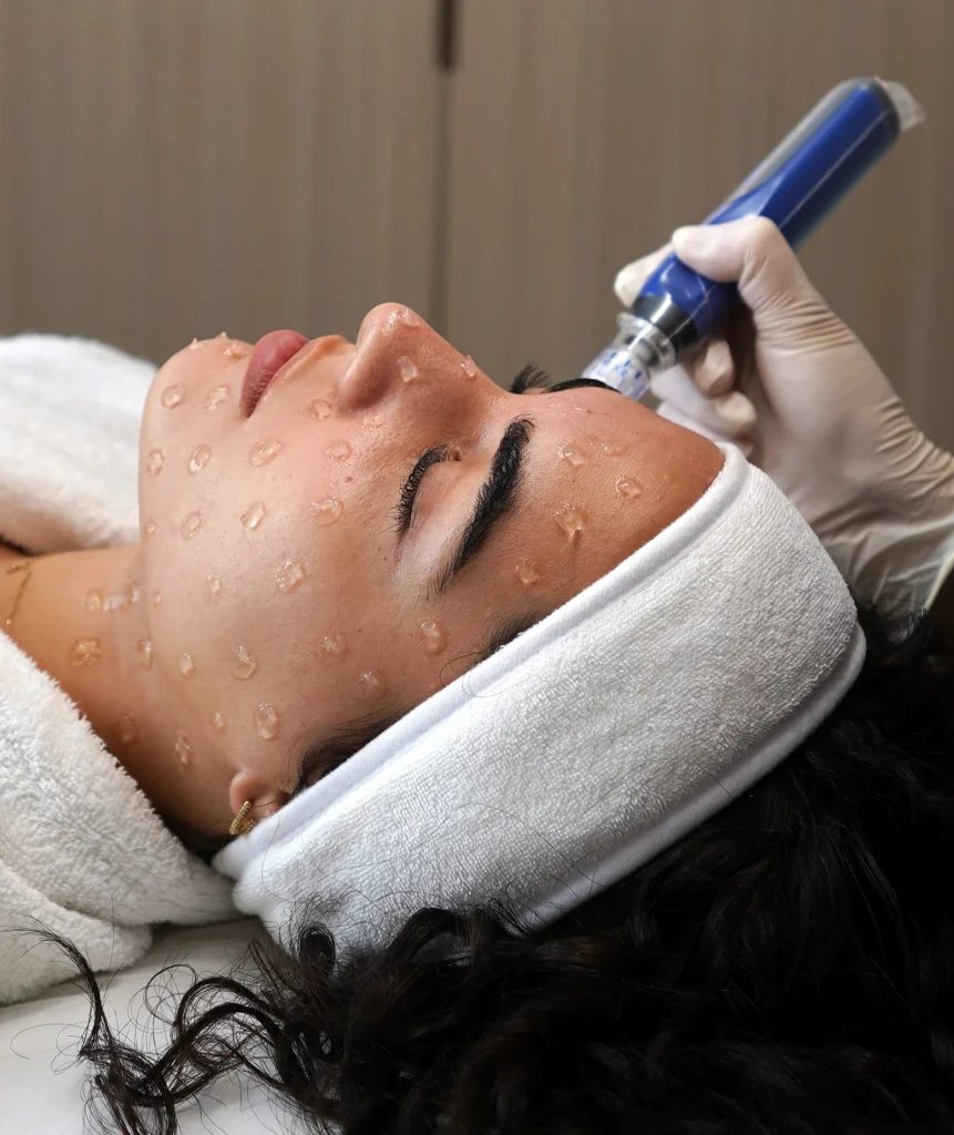 SkinPen Precision Elite microneedling treatment being carried out at a Fulham London clinic