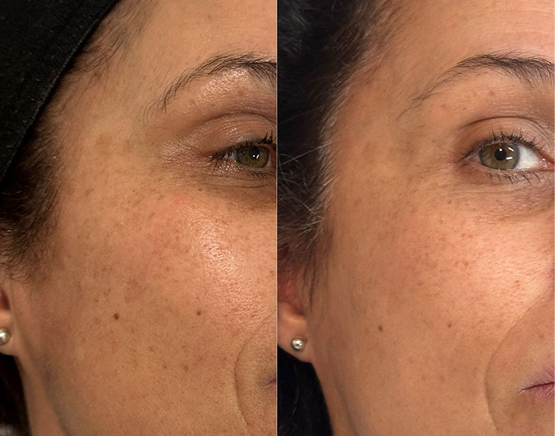 Before and after a course of microneedling, showing a more even skin tone and refined texture. Individual results vary.